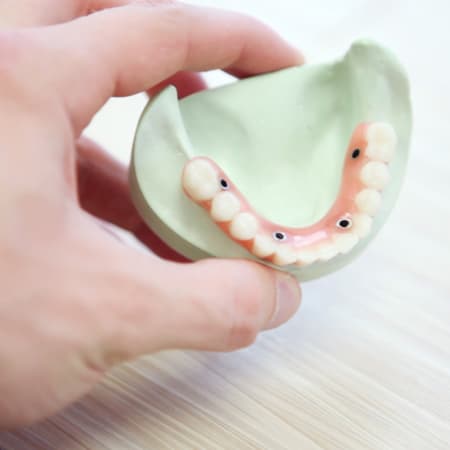 Implantes dentales all on four en clinica dental xana en aluche