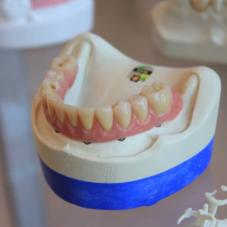 implantes dentales de carga inmediata en clinica dental xana en aluche