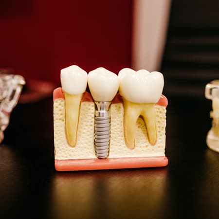 Implantes dentales en clinica dental xana en aluche